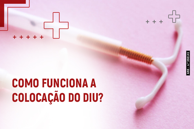 Como funciona a colocação do DIU?